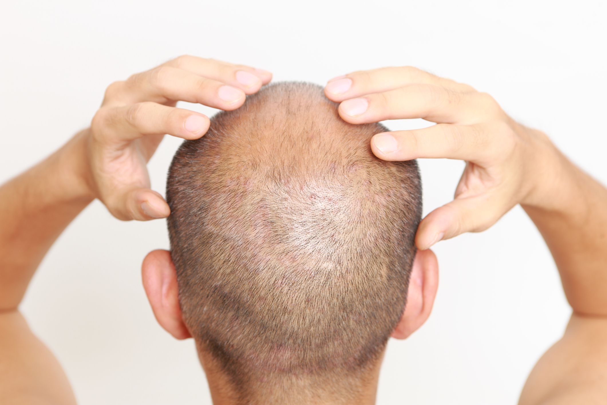 Numankind Do hair loss medications have side effects